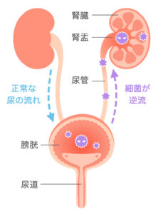 膀胱炎のアイキャッチ画像